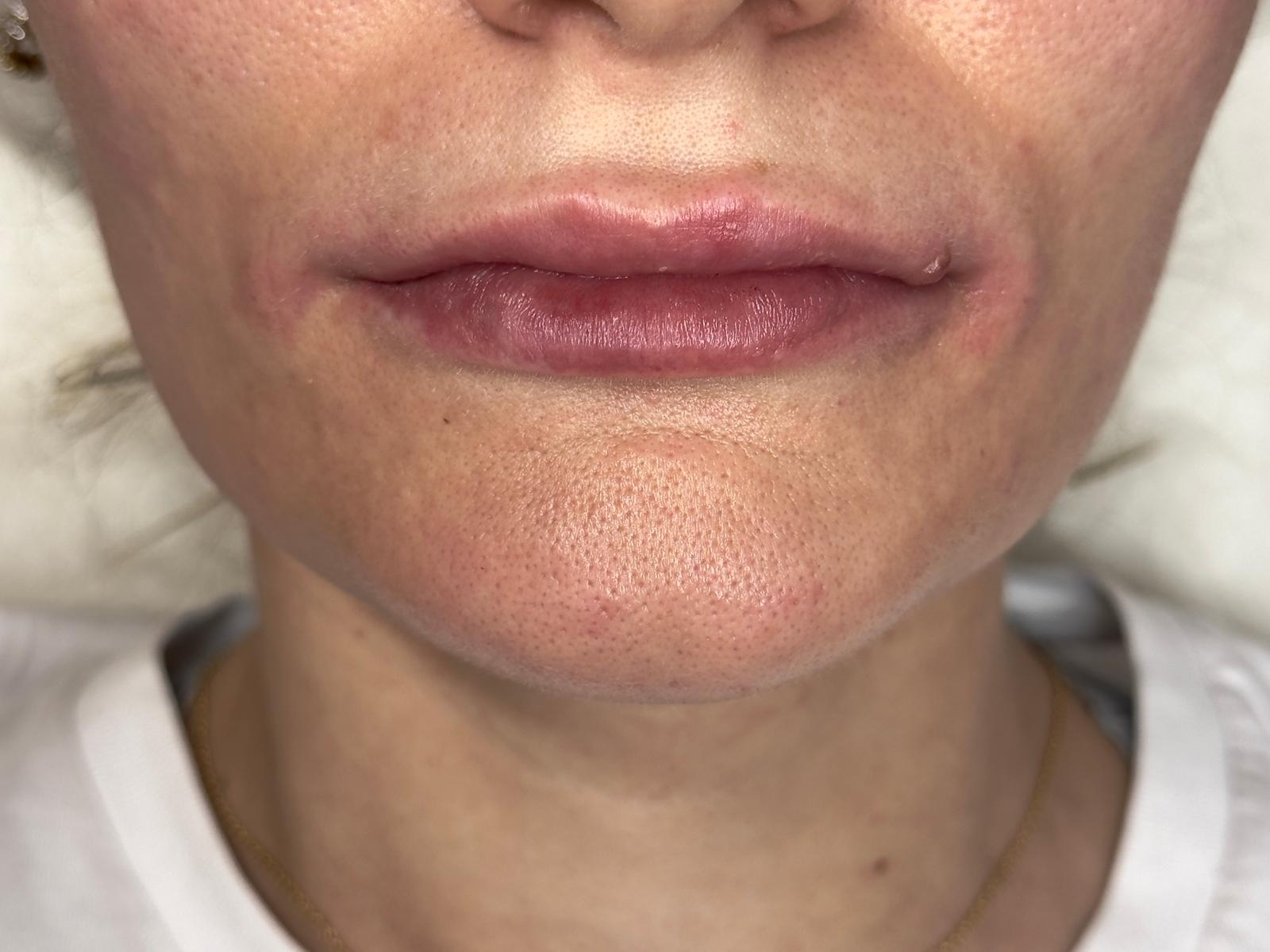 Prima - Filler Mento