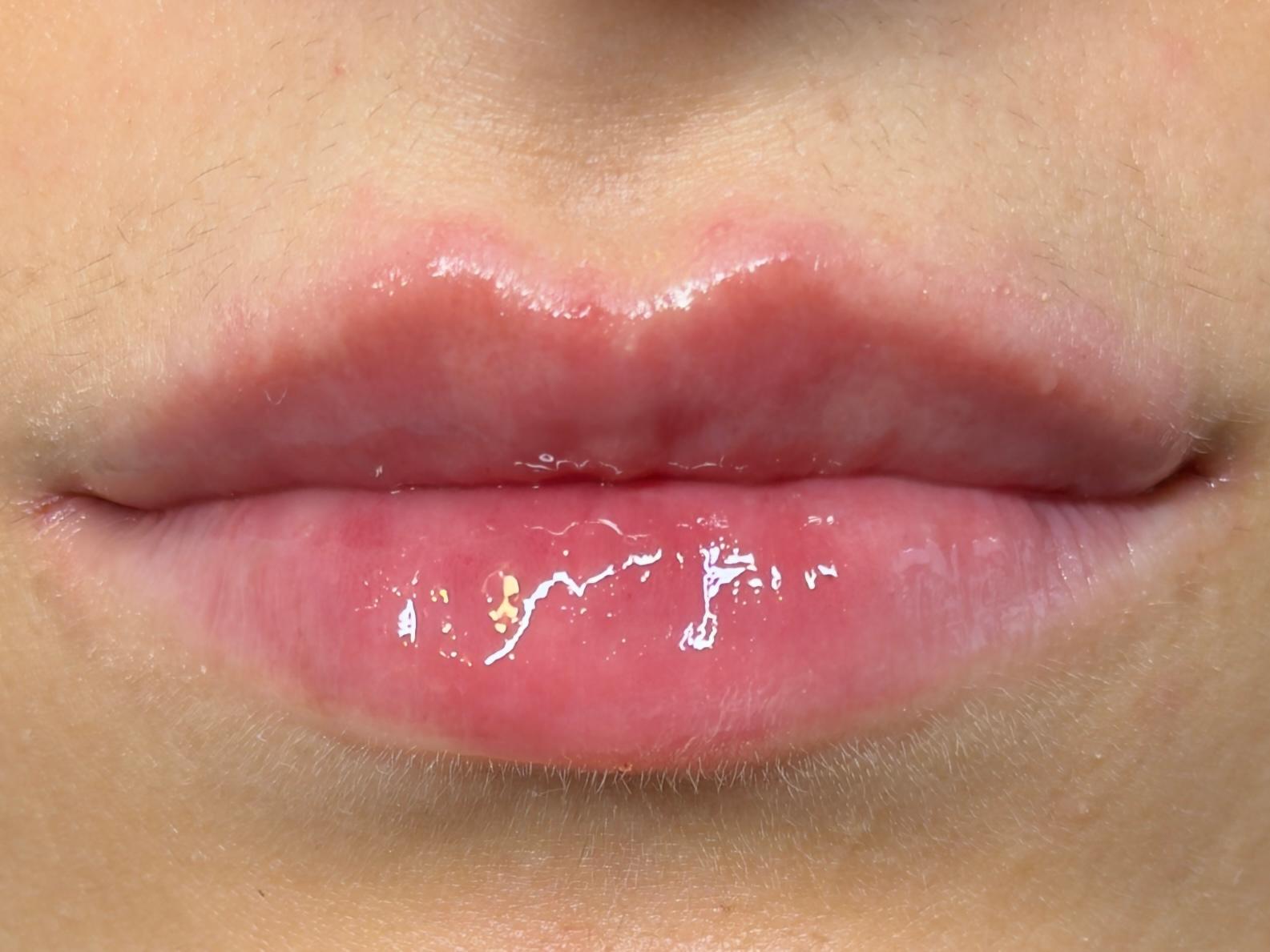 Prima - Filler Labbra