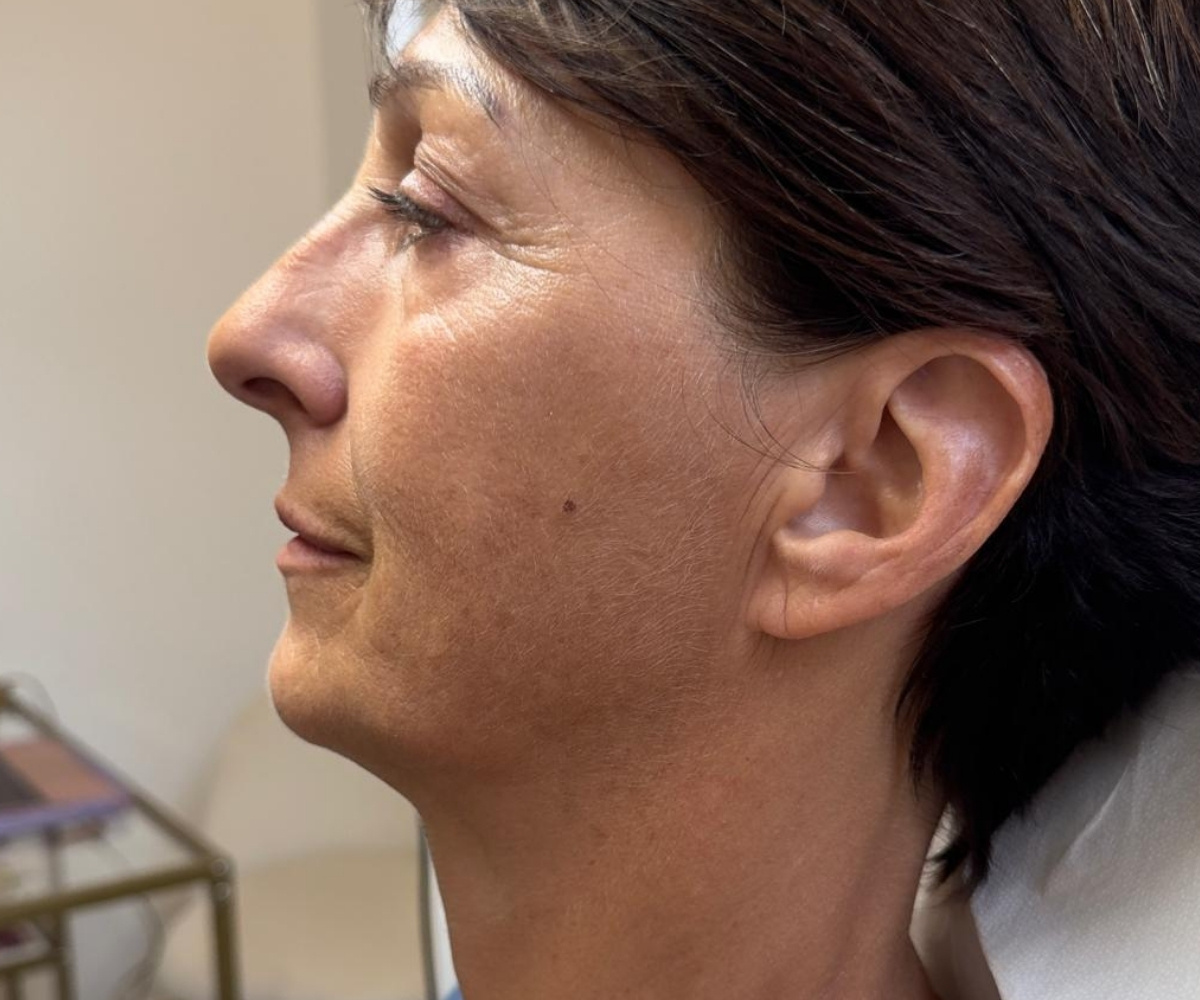 Prima - Idrossiapatite di Calcio