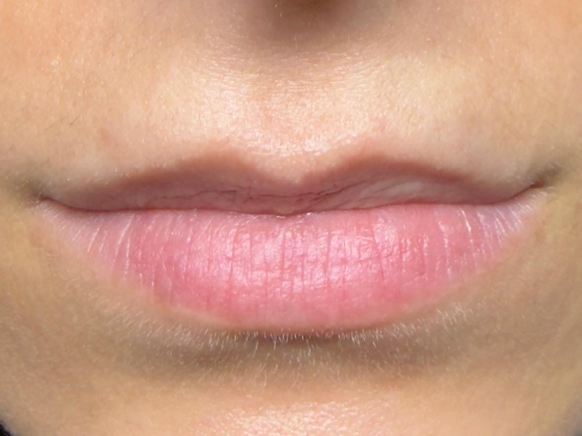 Dopo - Filler Labbra