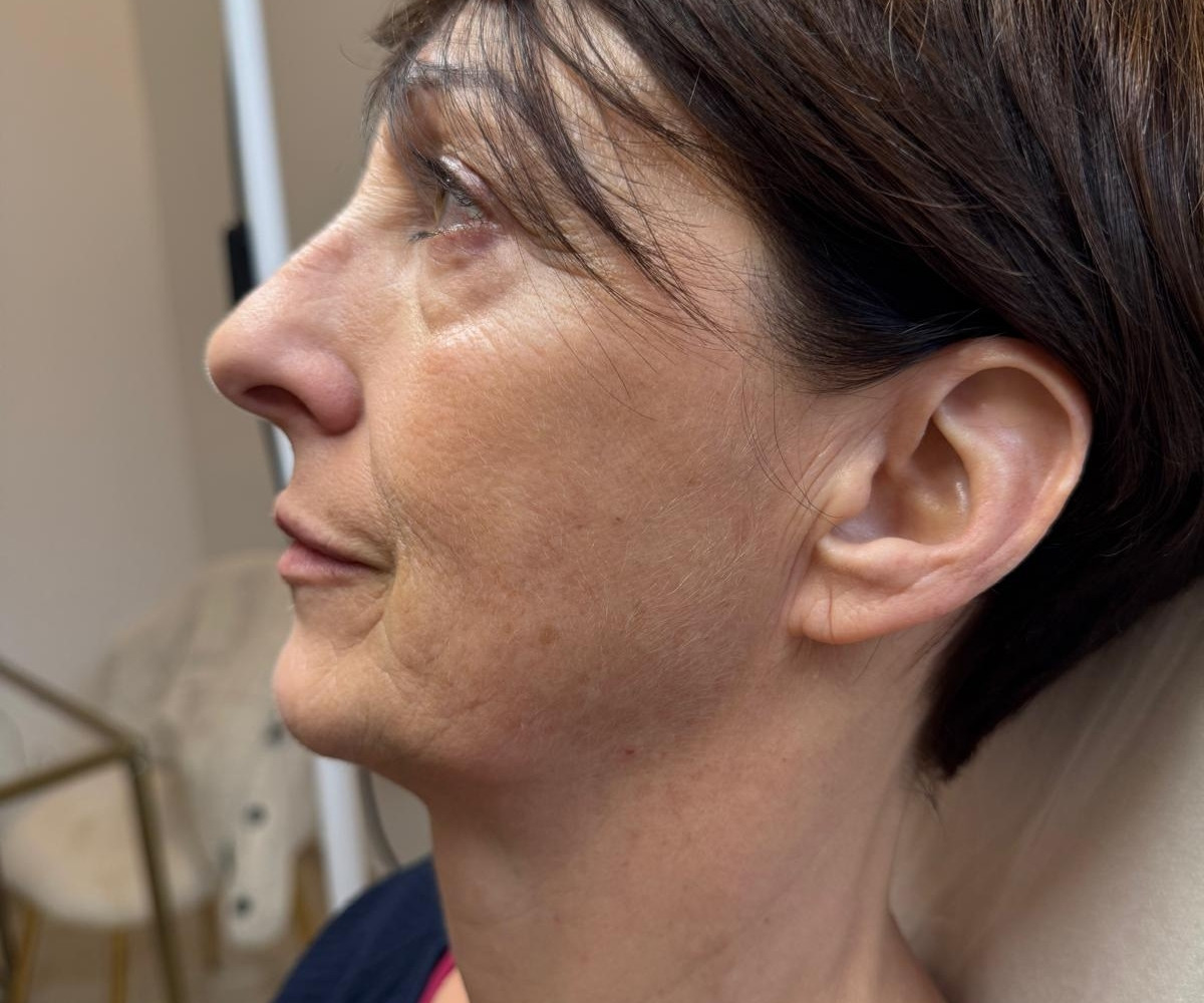 Dopo - Idrossiapatite di Calcio